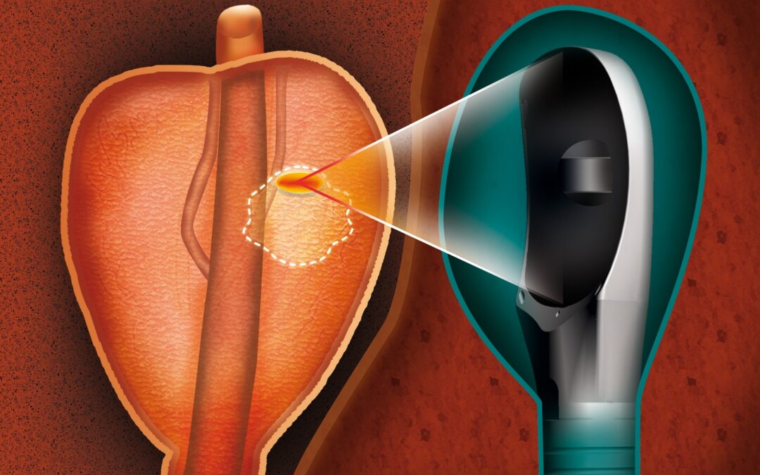 Focal-One_Ablation-Illustratoin