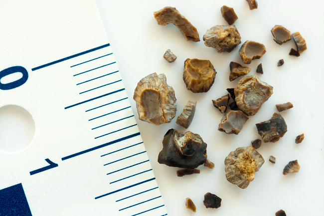 Dealing with the pain of kidney stones