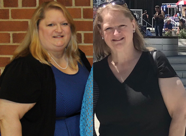 before and after bariatric surgery