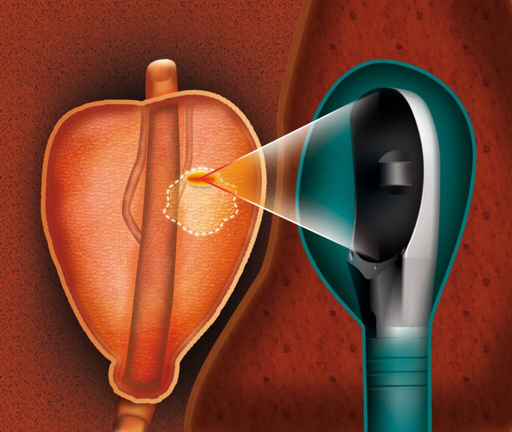 Erlanger Focal HIFU